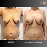 Efekty przed i po mommy makeover w ID Clinic Bangkok – modelowanie piersi i brzucha