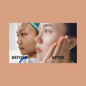 Before and after ethnic rhinoplasty results at ID Clinic Bangkok, improved nose profile