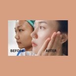 Before and after ethnic rhinoplasty results at ID Clinic Bangkok, improved nose profile