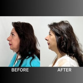 Before and after ethnic rhinoplasty results at ID Clinic Bangkok, improved nose profile