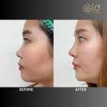 Before and after ethnic rhinoplasty results at ID Clinic Bangkok, improved nose profile