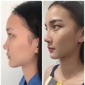 Before and after ethnic rhinoplasty results at ID Clinic Bangkok, nose reshaping improvement
