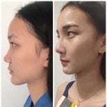 Before and after ethnic rhinoplasty results at ID Clinic Bangkok, nose reshaping improvement