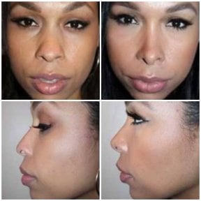 Before and after ethnic rhinoplasty results at ID Clinic Bangkok, nose reshaping improvement