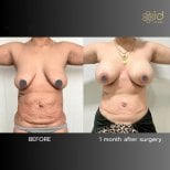 Resultados de lifting de senos y abdominoplastia antes y después en ID Clinic Bangkok, 1 mes