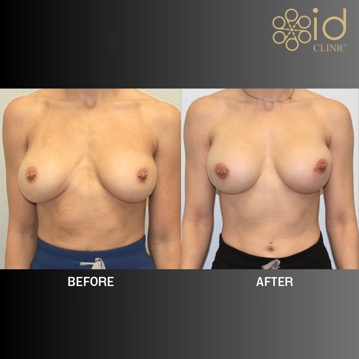نتائج تصحيح غرسات الثدي قبل وبعد في ID Clinic Bangkok مع تحسين شكل الثدي