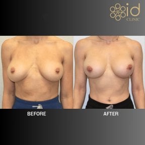 До та після корекції грудних імплантів в ID Clinic Bangkok, покращена форма грудей