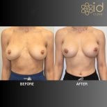 До та після корекції грудних імплантів в ID Clinic Bangkok, покращена форма грудей