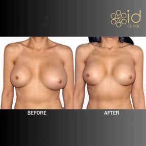 Before and after breast implant revision results at ID Clinic Bangkok, improved breast shape