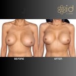 Before and after breast implant revision results at ID Clinic Bangkok, improved breast shape