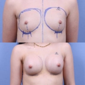 Before and after breast augmentation at Optimed International Hospital, fuller breast result