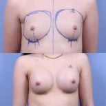 Before and after breast augmentation at Optimed International Hospital, fuller breast result