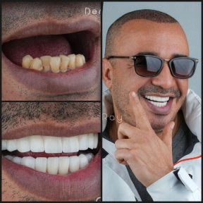before-after photo dental-crown-installation