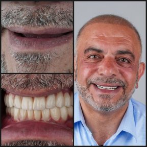 before-after photo dental-crown-installation