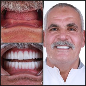 before-after photo dental-crown-installation