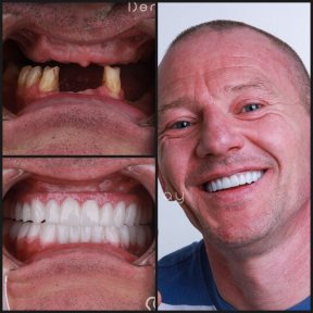 before-after photo dental-crown-installation