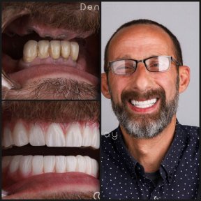before-after photo dental-crown-installation