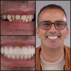 before-after photo dental-crown-installation