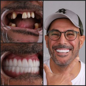 before-after photo dental-crown-installation