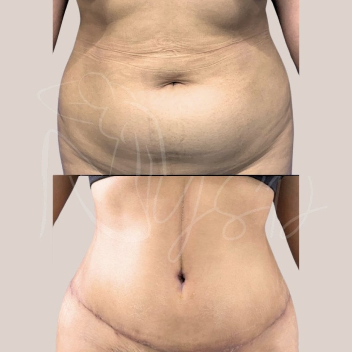 Resultados de abdominoplastia antes y después en Dr. Yazmin Sánchez Delgado, abdomen plano