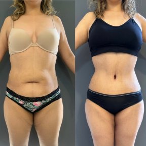 before-after photo abdominoplasty