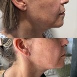 Результаты до и после подтяжки лица у Dr. Yazmin Sánchez Delgado, улучшение линии подбородка