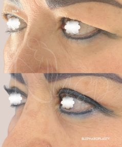 before-after photo blepharoplasty-eyelid