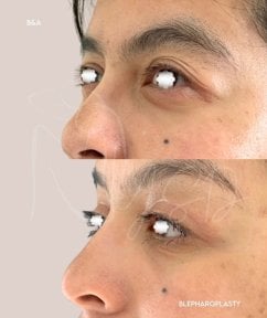 before-after photo blepharoplasty-eyelid