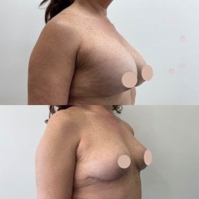Before and after breast implants with lift results at Dr. Yazmin Sánchez Delgado clinic