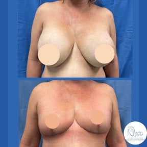 before-after photo breast-implant-removal