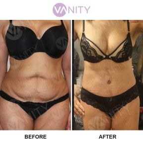 Before and after tummy tuck results at Vanity Cosmetic Surgery Center, flatter abdomen shown