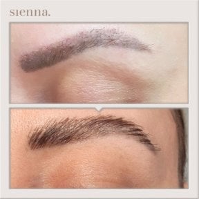 before-after photo fue-hair-transplant