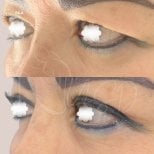 Blepharoplasty before and after results at Dr. Yazmin Sánchez Delgado, eyelid correction