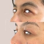 Blepharoplasty before and after results at Dr. Yazmin Sánchez Delgado, eyelid correction