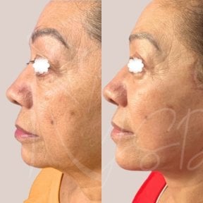 Facelift Vorher-Nachher-Ergebnis bei Dr. Yazmin Sánchez Delgado, sichtbare Verjüngung