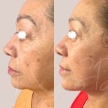 Facelift Vorher-Nachher-Ergebnis bei Dr. Yazmin Sánchez Delgado, sichtbare Verjüngung