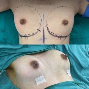 before-after photo breast-augmentation