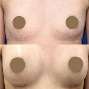 before-after photo breast-augmentation