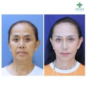 Résultats avant et après lifting du visage à Intrarat Hospital – rajeunissement visible