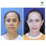 Résultats avant et après lifting du visage à Intrarat Hospital – rajeunissement visible