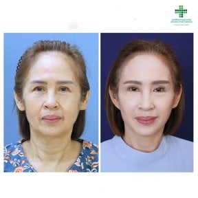 Before and after facelift results at Intrarat Hospital, facial rejuvenation and smoother skin