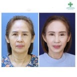 Before and after facelift results at Intrarat Hospital, facial rejuvenation and smoother skin
