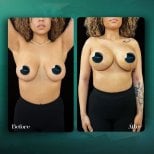 Before and after breast implants with lift at Grand Clinic, enhanced breast shape results