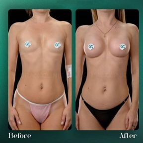 Before and after breast implants with lift at Grand Clinic – enhanced breast shape result