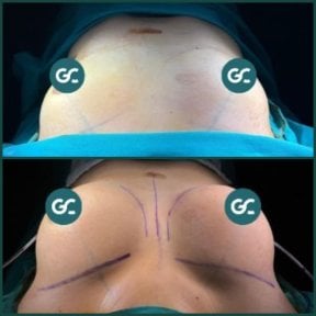 Before and after breast implants with lift results at Grand Clinic – enhanced breast contour