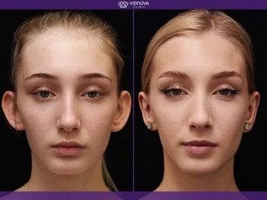 Before and after otoplasty results at Vidnova Clinic – improved ear shape and symmetry