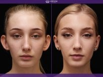 Before and after otoplasty results at Vidnova Clinic – improved ear shape and symmetry