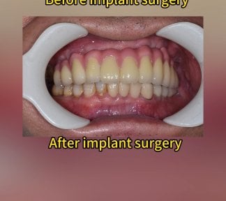 before-after photo tooth-whitening