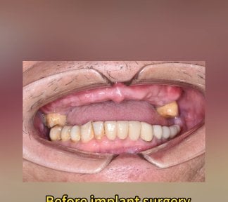 before-after photo tooth-whitening
