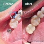 نتيجة قبل وبعد زراعة الأسنان مع التاج في Pulvet Dentist Group، ترميم الضرس
